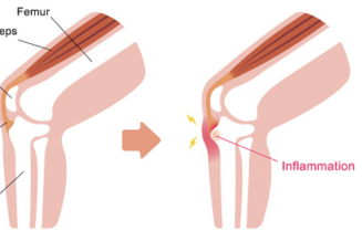 Osgood Schlatter Rehab, com gestionar-la?